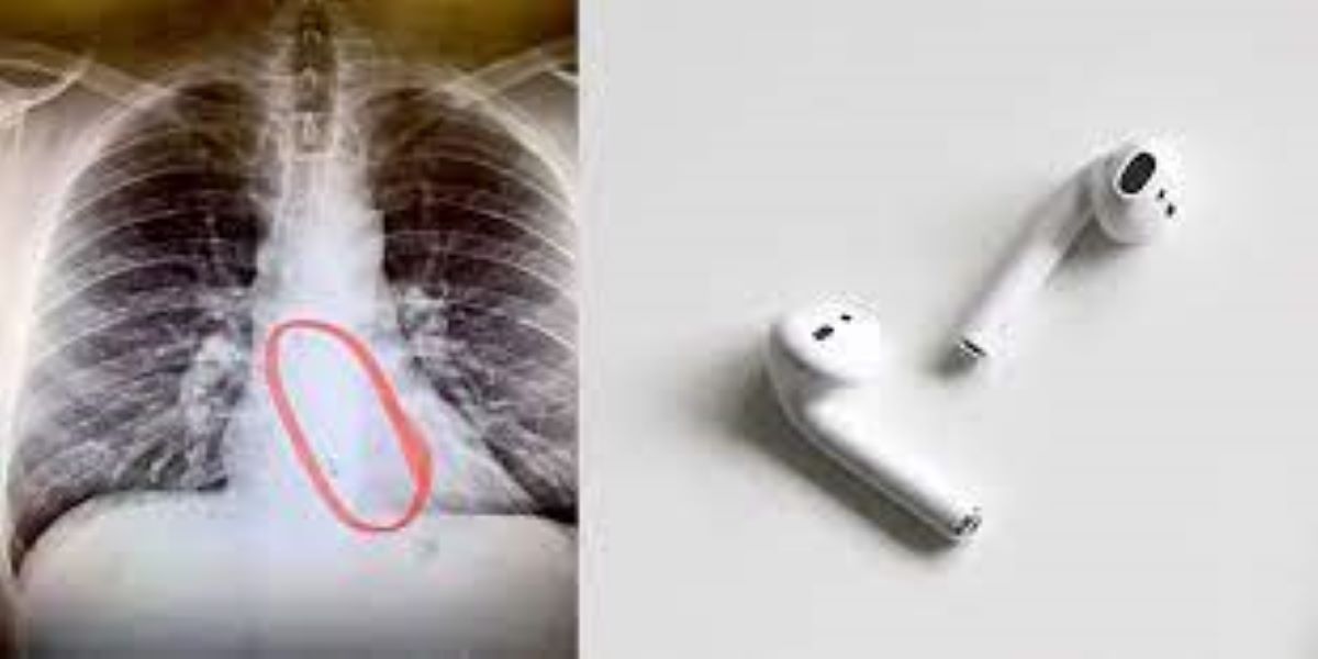 A young man swallowed the AirPods down his throat while sleeping