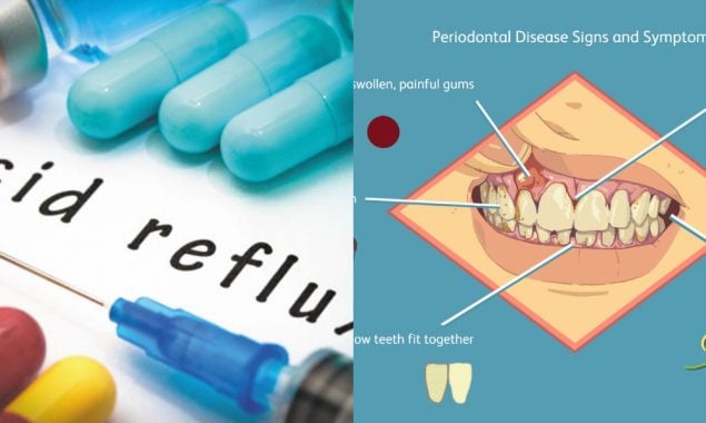 heartburn drugs may help in improving gum disease