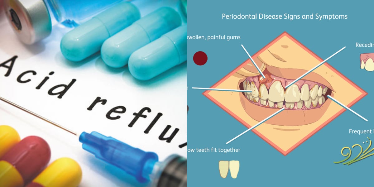 heartburn drugs may help in improving gum disease