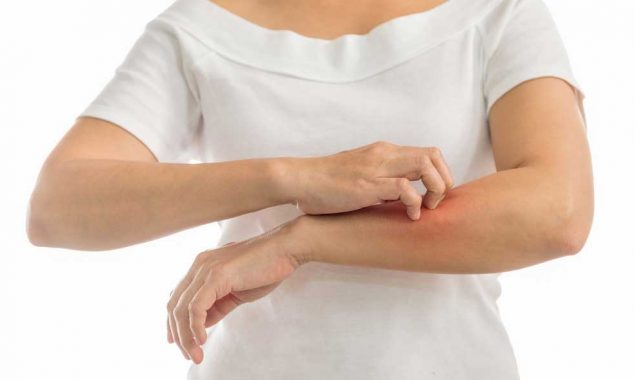 Try these 3 natural remedies for eczema relief
