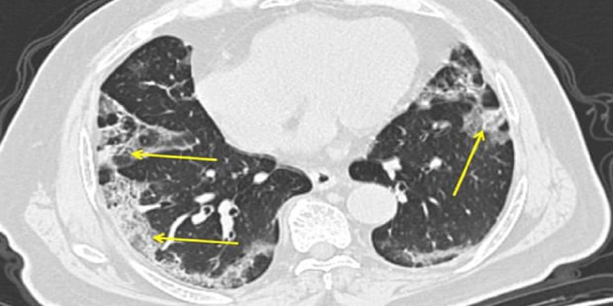 COVID-19 infections accelerate lung aging: study
