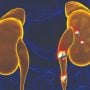 Climate change may cause more kidney stones