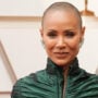Jada Pinkett Smith talks about her Alopecia struggles
