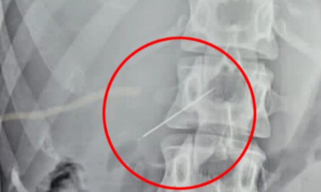 WATCH: A woman horrifyingly swallow sewing needle