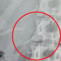 WATCH: A woman horrifyingly swallow sewing needle