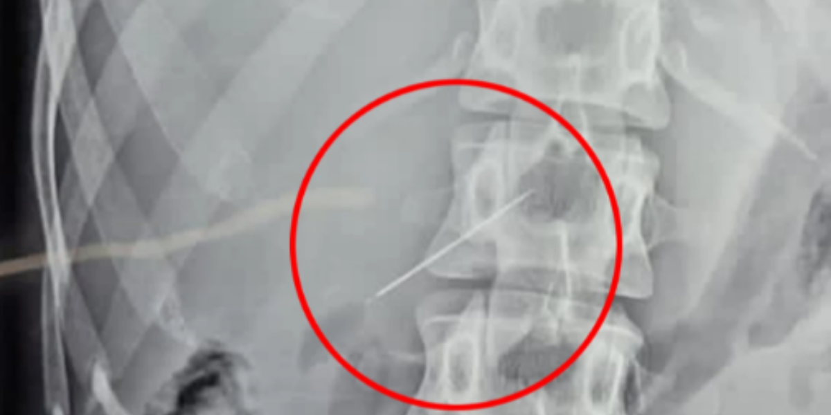 WATCH: a woman horrifyingly swallow sewing needle