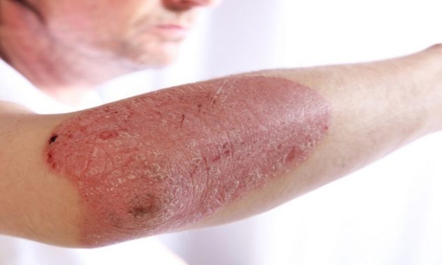 Skin cancer cases on rise in Australia