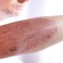 Skin cancer cases on rise in Australia