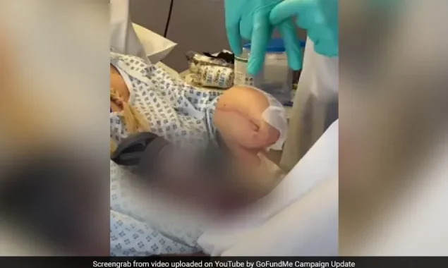 After a battle with sepsis, a woman in the United Kingdom was left with a ‘Shark Hand.’