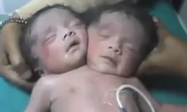 Baby is born with three arms, two heads and two hearts: Doctors amazed as infant survives