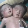 Baby is born with three arms, two heads and two hearts: Doctors amazed as infant survives