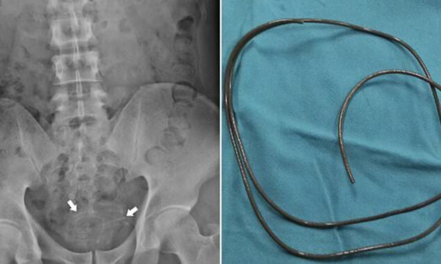 A headphone wire was found in the bladder of an Indonesian man