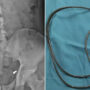 A headphone wire was found in the bladder of an Indonesian man