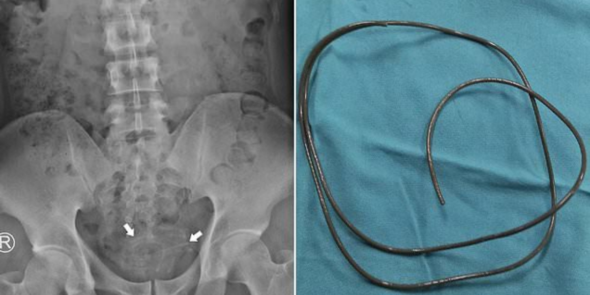 A headphone wire was found in the bladder of an Indonesian man