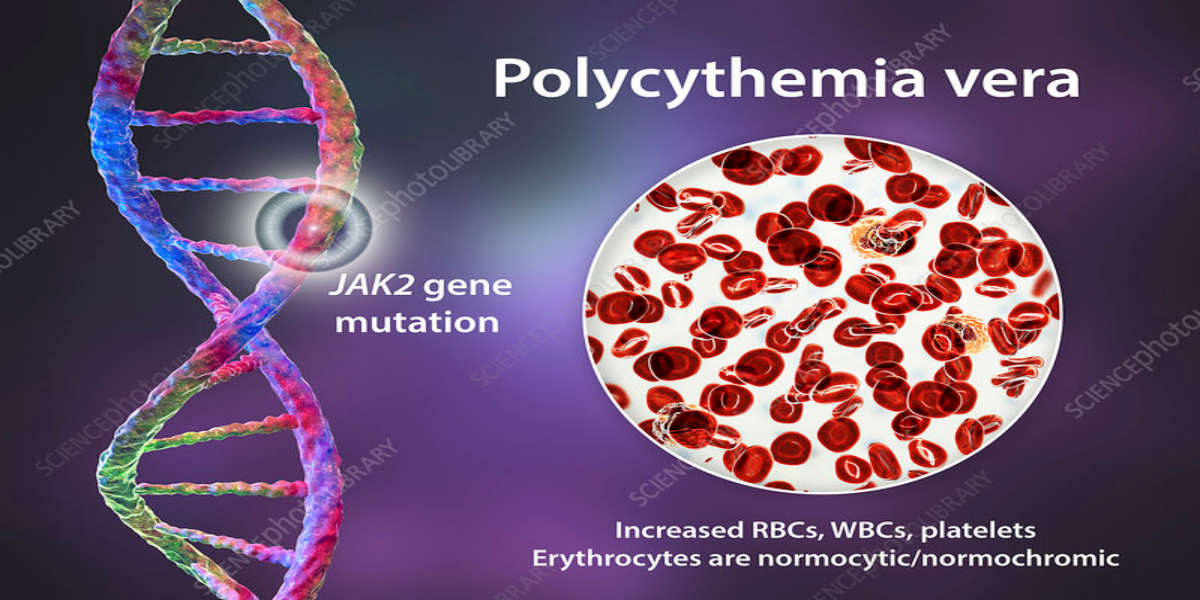 Gene mutation causing polycythemia vera BOL News