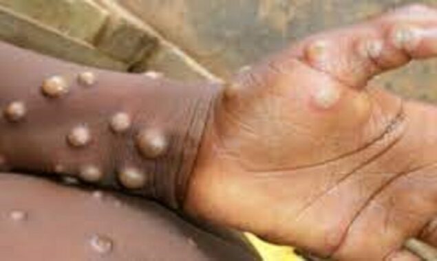 Belgium is first country to impose strict monkeypox quarantine as global cases rise