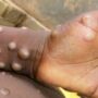 Belgium is first country to impose strict monkeypox quarantine as global cases rise