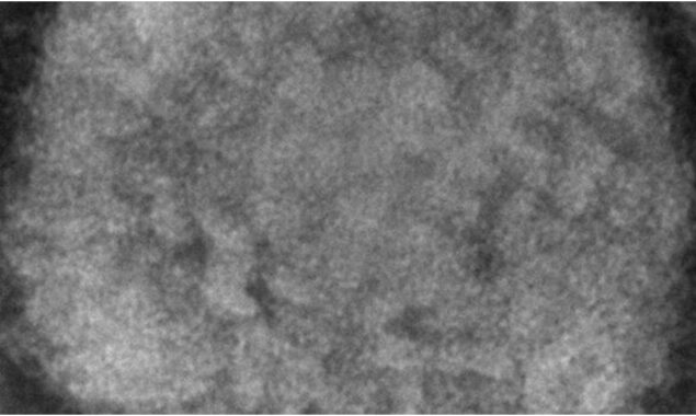 Massachusetts man has been diagnosed with monkeypox in US