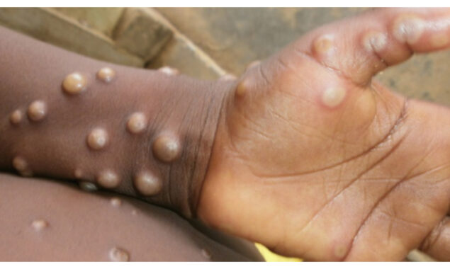UK is seeing a ‘significant increase’ in instances of monkeypox