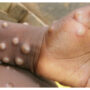 UK is seeing a ‘significant increase’ in instances of monkeypox