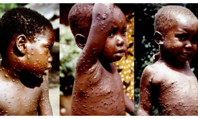 monkeypox