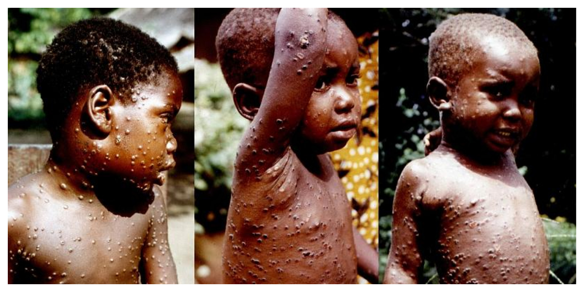 monkeypox