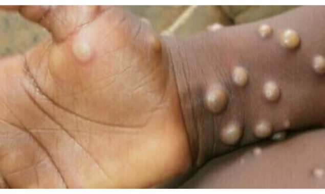Roche develops monkeypox PCR tests