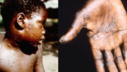 Officials says UK monkeypox outbreak as “unprecedented,” with sexual contact as the most likely route of transmission