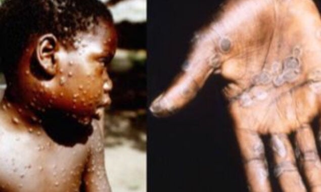 Officials says UK monkeypox outbreak as "unprecedented," with sexual contact as the most likely route of transmission