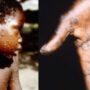 Officials says UK monkeypox outbreak as “unprecedented,” with sexual contact as the most likely route of transmission