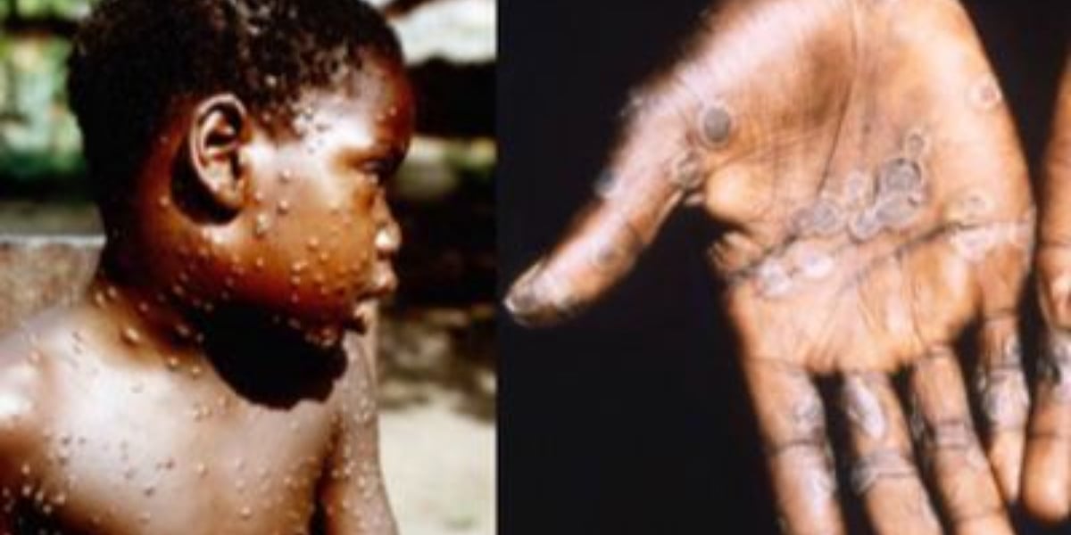 Officials says UK monkeypox outbreak as "unprecedented," with sexual contact as the most likely route of transmission