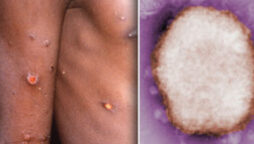 England: found four verified cases of monkeypox