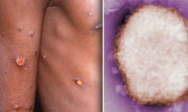 England: found four verified cases of monkeypox
