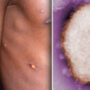 England: found four verified cases of monkeypox