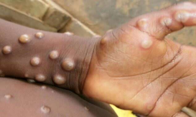 Biden says ‘extra efforts’ not needed against monkeypox