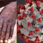 Probability of Pandemic? How is it different from chicken pox? Monkeypox Q/A