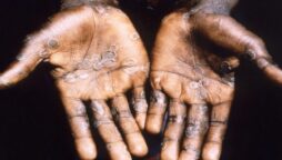 monkeypox