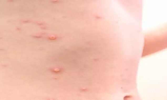 Scotland quarantines people who have been in contact with England’s monkeypox patient