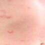 WHO calls emergency meeting as monkeypox cases top 100 in Europe