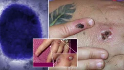 Monkeypox in the United States
