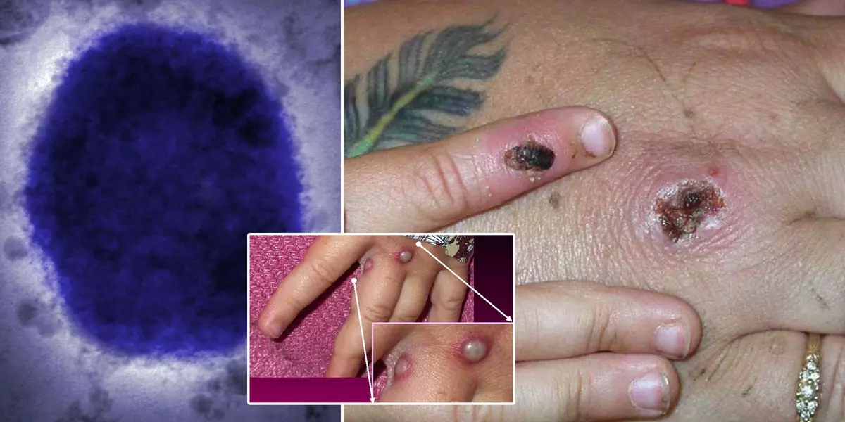 Monkeypox in the United States