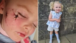 After a dog bit her face, my three-year-old daughter needed plastic surgery