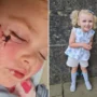 After a dog bit her face, my three-year-old daughter needed plastic surgery