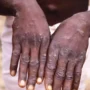 WHO declares monkeypox a global emergency