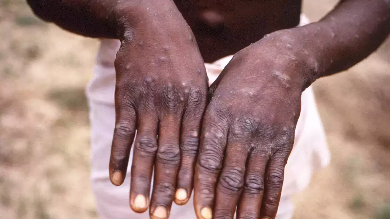 monkeypox global emergency