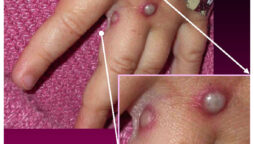 UK monkeypox symptoms different to prior outbreaks: study