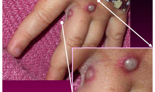 monkeypox virus