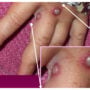 UK monkeypox symptoms different to prior outbreaks: study