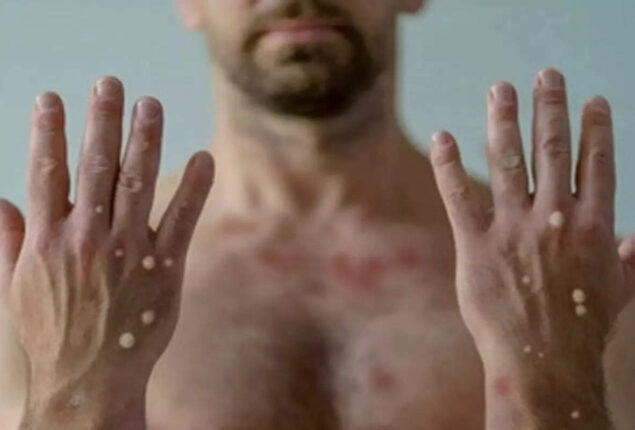 Monkeypox outbreak emergency is declared in New York