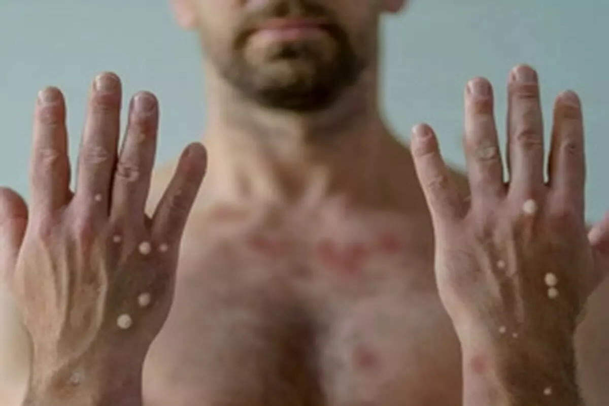 Monkeypox